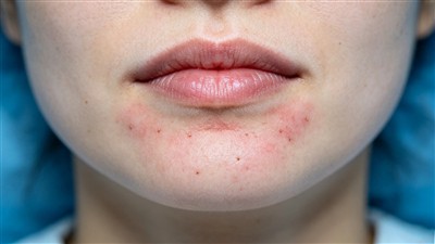 Quanto tempo dura a vermelhidão após as injeções de preenchimento de queixo?